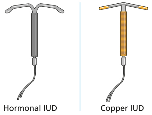 Images of a hormonal IUD and a copper IUD