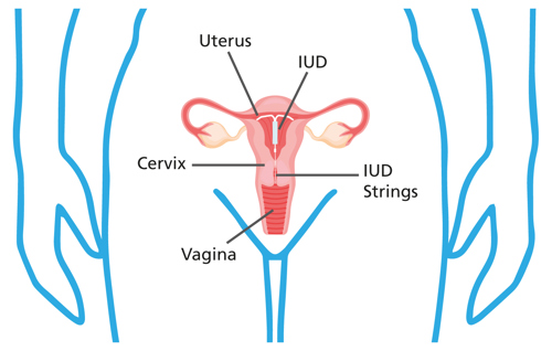 Image of a fitted IUD.
